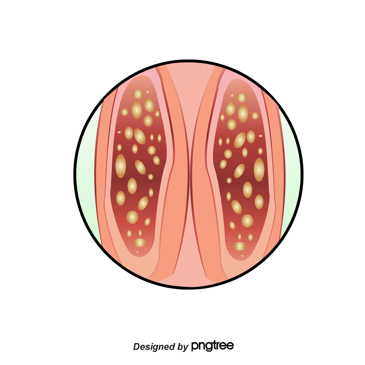 Pngtreehuman esophageal cancer 1260322 1