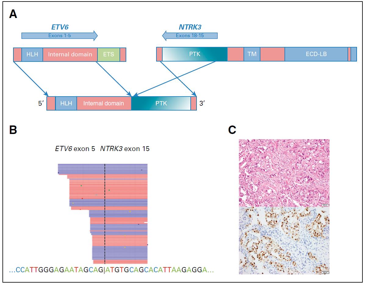 Successful Targeted Therapy of 1