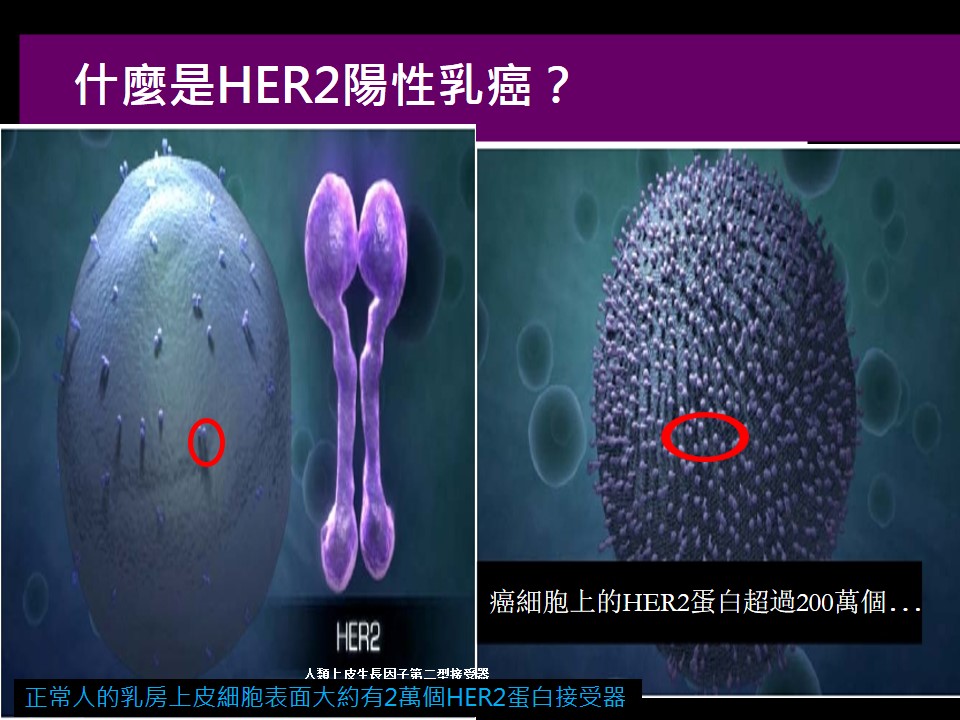 更方便省時 乳癌標靶藥皮下注射新劑型 1