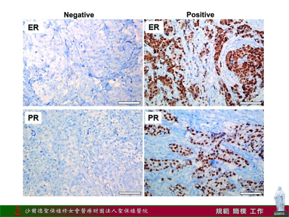 管腔型荷爾蒙受體陽性乳癌4