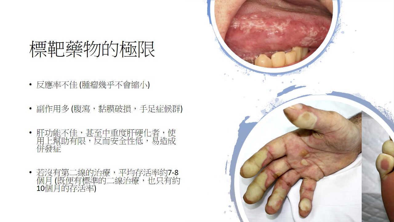 腸胃道消化系統腫瘤與免疫治療 2