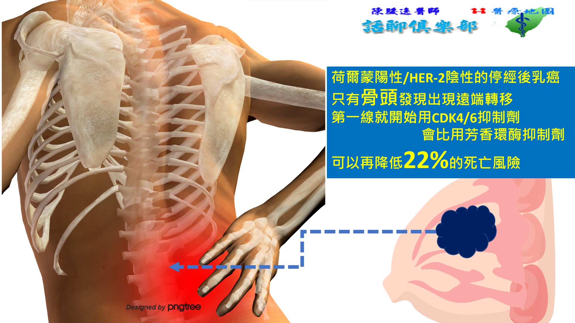 骨頭發現出現遠端轉移第一線就用CD4 6抑制劑0003