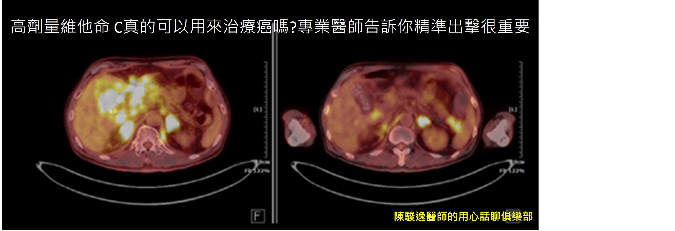 高劑量維他命 C真的可以用來治療癌嗎